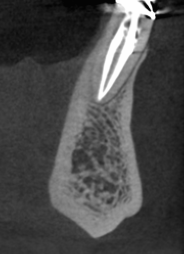 5x5-Tooth-fracture-small