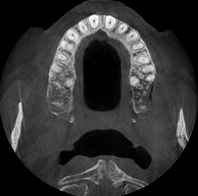 EOIS-9x10-Maxilla